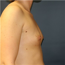 Breast Augmentation Before Photo by Steve Laverson, MD, FACS; Rancho Santa Fe, CA - Case 40431