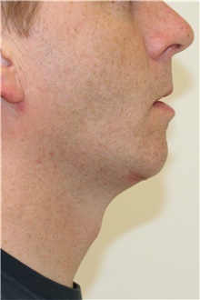 Chin Augmentation After Photo by Steve Laverson, MD, FACS; Rancho Santa Fe, CA - Case 40436