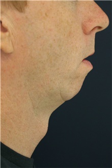 Chin Augmentation Before Photo by Steve Laverson, MD, FACS; Rancho Santa Fe, CA - Case 40436