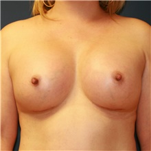 Breast Augmentation After Photo by Steve Laverson, MD, FACS; Rancho Santa Fe, CA - Case 40538