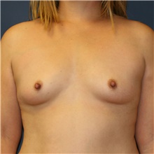 Breast Augmentation Before Photo by Steve Laverson, MD, FACS; Rancho Santa Fe, CA - Case 40538