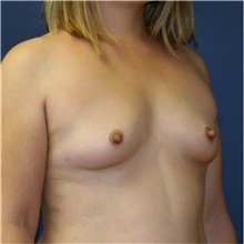 Breast Augmentation Before Photo by Steve Laverson, MD, FACS; Rancho Santa Fe, CA - Case 40538