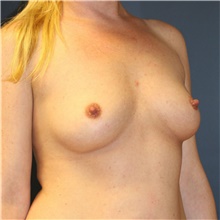 Breast Augmentation Before Photo by Steve Laverson, MD, FACS; Rancho Santa Fe, CA - Case 40539