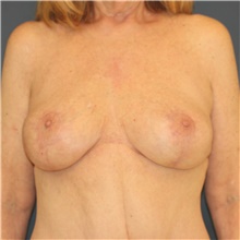 Breast Implant Revision After Photo by Steve Laverson, MD, FACS; Rancho Santa Fe, CA - Case 40540