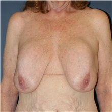 Breast Implant Revision Before Photo by Steve Laverson, MD, FACS; Rancho Santa Fe, CA - Case 40540