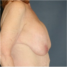 Breast Implant Revision Before Photo by Steve Laverson, MD, FACS; Rancho Santa Fe, CA - Case 40540