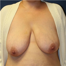 Breast Lift Before Photo by Steve Laverson, MD; San Diego, CA - Case 40541