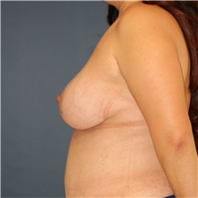 Breast Lift After Photo by Steve Laverson, MD; San Diego, CA - Case 40541