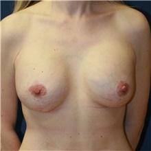 Breast Lift After Photo by Steve Laverson, MD, FACS; Rancho Santa Fe, CA - Case 40547