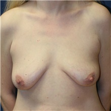 Breast Lift Before Photo by Steve Laverson, MD, FACS; Rancho Santa Fe, CA - Case 40547