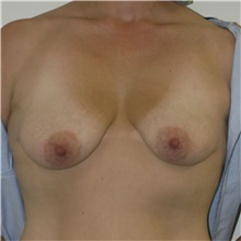 Breast Lift Before Photo by Steve Laverson, MD, FACS; Rancho Santa Fe, CA - Case 40548