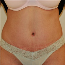 Tummy Tuck After Photo by Steve Laverson, MD; San Diego, CA - Case 40570