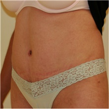 Tummy Tuck After Photo by Steve Laverson, MD; San Diego, CA - Case 40570