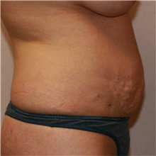 Tummy Tuck Before Photo by Steve Laverson, MD; San Diego, CA - Case 40570