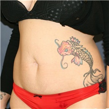 Tummy Tuck Before Photo by Steve Laverson, MD, FACS; Rancho Santa Fe, CA - Case 40599