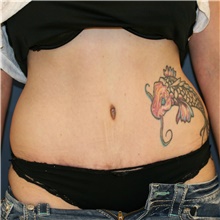 Tummy Tuck After Photo by Steve Laverson, MD, FACS; Rancho Santa Fe, CA - Case 40599