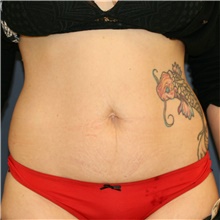 Tummy Tuck Before Photo by Steve Laverson, MD, FACS; Rancho Santa Fe, CA - Case 40599