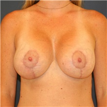 Breast Lift After Photo by Steve Laverson, MD, FACS; Rancho Santa Fe, CA - Case 40600
