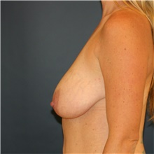 Breast Lift Before Photo by Steve Laverson, MD, FACS; Rancho Santa Fe, CA - Case 40600