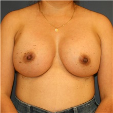 Breast Augmentation After Photo by Steve Laverson, MD, FACS; Rancho Santa Fe, CA - Case 40601