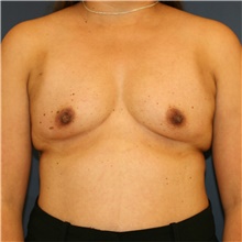 Breast Augmentation Before Photo by Steve Laverson, MD, FACS; Rancho Santa Fe, CA - Case 40601