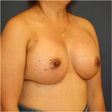 Breast Augmentation After Photo by Steve Laverson, MD, FACS; Rancho Santa Fe, CA - Case 40601