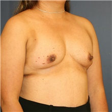 Breast Augmentation Before Photo by Steve Laverson, MD, FACS; Rancho Santa Fe, CA - Case 40601