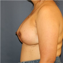 Breast Augmentation After Photo by Steve Laverson, MD, FACS; Rancho Santa Fe, CA - Case 40601