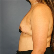 Breast Augmentation Before Photo by Steve Laverson, MD, FACS; Rancho Santa Fe, CA - Case 40601