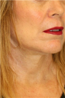 Neck Lift After Photo by Steve Laverson, MD, FACS; San Diego, CA - Case 40602