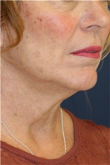 Neck Lift Before Photo by Steve Laverson, MD, FACS; San Diego, CA - Case 40602