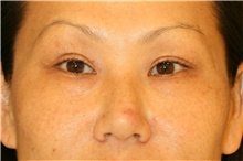 Eyelid Surgery After Photo by Steve Laverson, MD; San Diego, CA - Case 40610