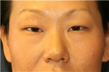 Eyelid Surgery Before Photo by Steve Laverson, MD; San Diego, CA - Case 40610