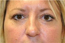 Eyelid Surgery After Photo by Steve Laverson, MD, FACS; Rancho Santa Fe, CA - Case 40611