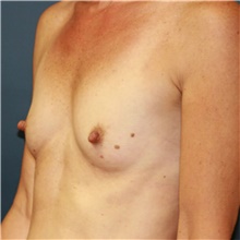 Breast Augmentation Before Photo by Steve Laverson, MD, FACS; San Diego, CA - Case 40629