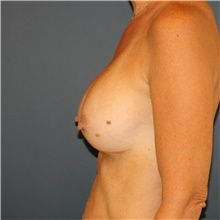 Breast Augmentation After Photo by Steve Laverson, MD, FACS; Rancho Santa Fe, CA - Case 40629