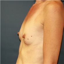 Breast Augmentation Before Photo by Steve Laverson, MD, FACS; Rancho Santa Fe, CA - Case 40629