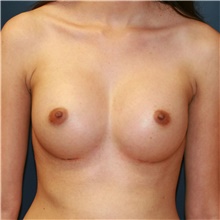Breast Augmentation After Photo by Steve Laverson, MD, FACS; San Diego, CA - Case 40637
