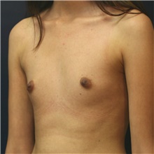 Breast Augmentation Before Photo by Steve Laverson, MD, FACS; Rancho Santa Fe, CA - Case 40637