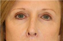 Eyelid Surgery After Photo by Steve Laverson, MD, FACS; Rancho Santa Fe, CA - Case 40638