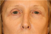 Eyelid Surgery Before Photo by Steve Laverson, MD, FACS; Rancho Santa Fe, CA - Case 40638