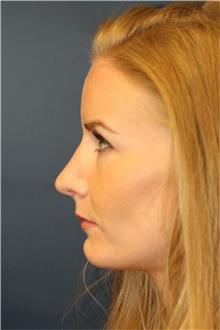 Rhinoplasty After Photo by Steve Laverson, MD, FACS; Rancho Santa Fe, CA - Case 40648