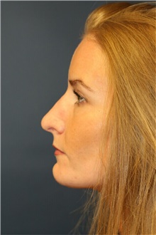 Rhinoplasty Before Photo by Steve Laverson, MD, FACS; Rancho Santa Fe, CA - Case 40648