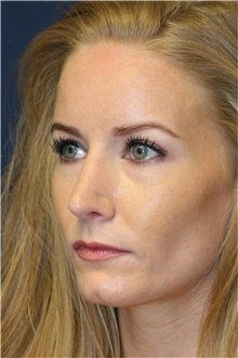 Rhinoplasty After Photo by Steve Laverson, MD, FACS; Rancho Santa Fe, CA - Case 40648