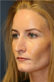 Rhinoplasty Before Photo by Steve Laverson, MD, FACS; Rancho Santa Fe, CA - Case 40648