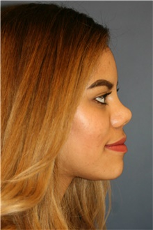 Rhinoplasty After Photo by Steve Laverson, MD, FACS; Rancho Santa Fe, CA - Case 40660