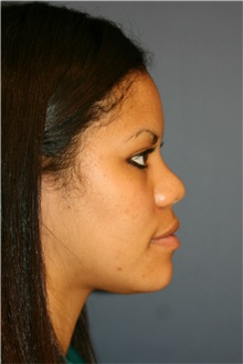 Rhinoplasty Before Photo by Steve Laverson, MD, FACS; Rancho Santa Fe, CA - Case 40660