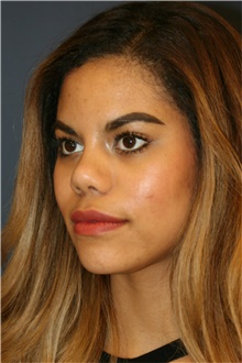 Rhinoplasty After Photo by Steve Laverson, MD, FACS; Rancho Santa Fe, CA - Case 40660