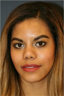 Rhinoplasty After Photo by Steve Laverson, MD, FACS; Rancho Santa Fe, CA - Case 40660