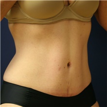 Tummy Tuck After Photo by Steve Laverson, MD, FACS; San Diego, CA - Case 40687